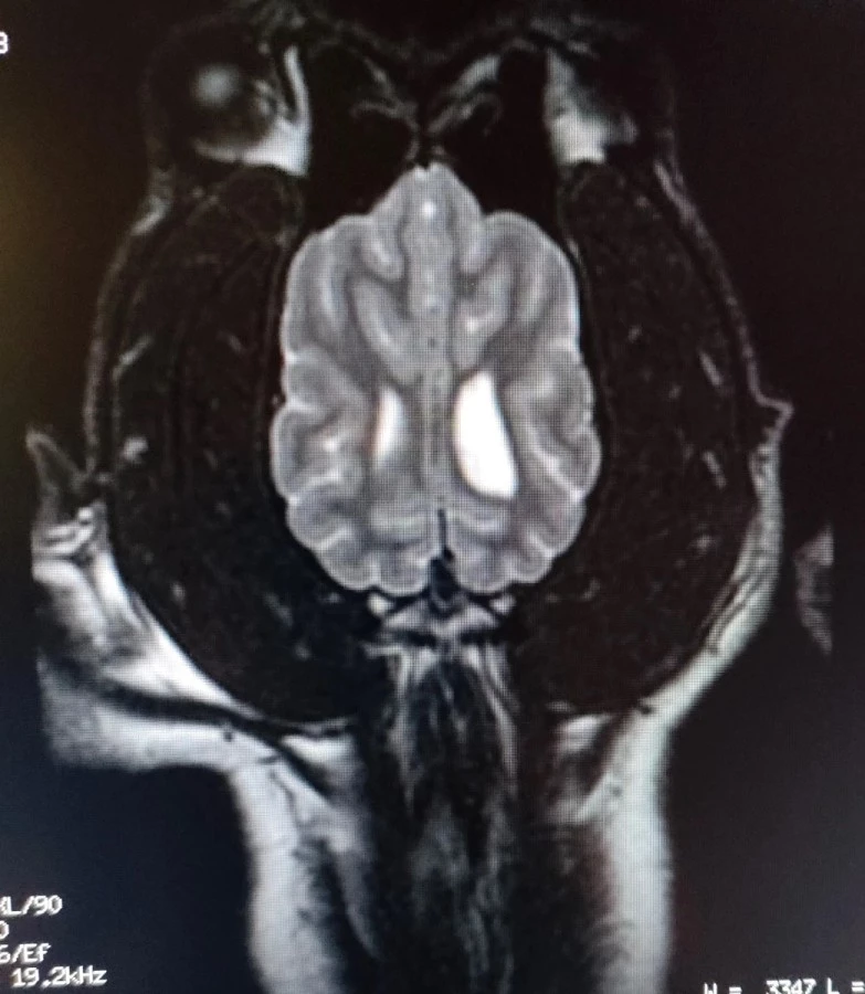 Obraz badania MRI dla prawidłowego mózgowia